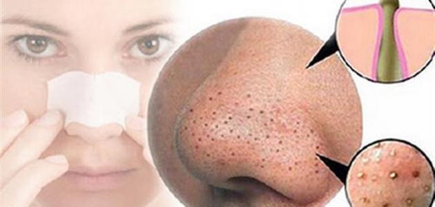 طرق طبيعية لإزالة البقع السوداء من الوجه