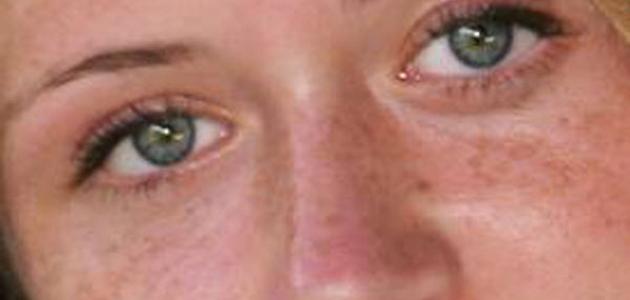 وصفات فعالة لإزالة الكلف عن الوجه