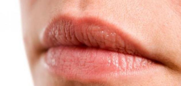 جفاف الشفاه: الأسباب والوقاية والعلاج