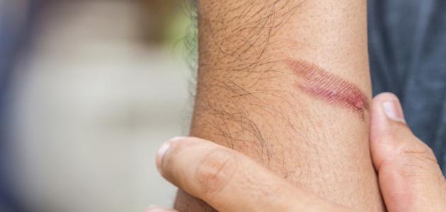 أفضل الكريمات والطرق لعلاج آثار الحروق