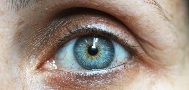 أسباب ظهور الهالات السوداء وكيفية التعامل معها