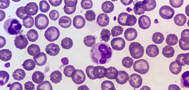 أسباب وأعراض ارتفاع اليوريا في الدم