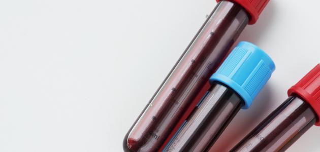 أسباب ارتفاع حمض البوليك في الدم وطرق العلاج